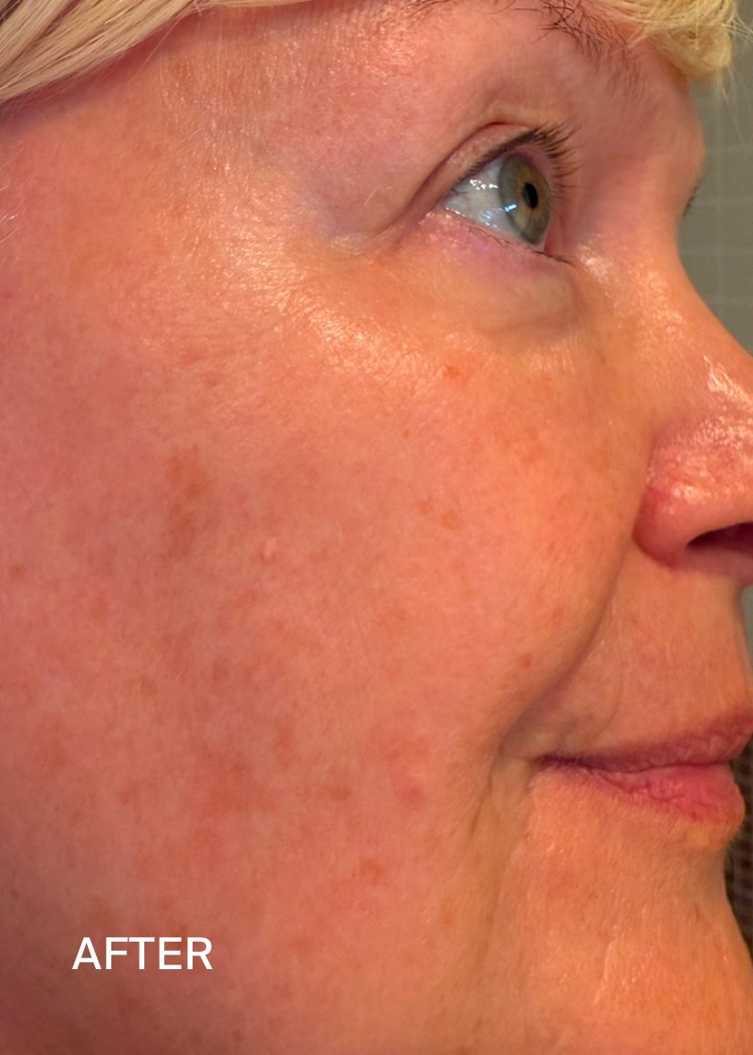 After: the same cheek, photographed after 12 weeks of use