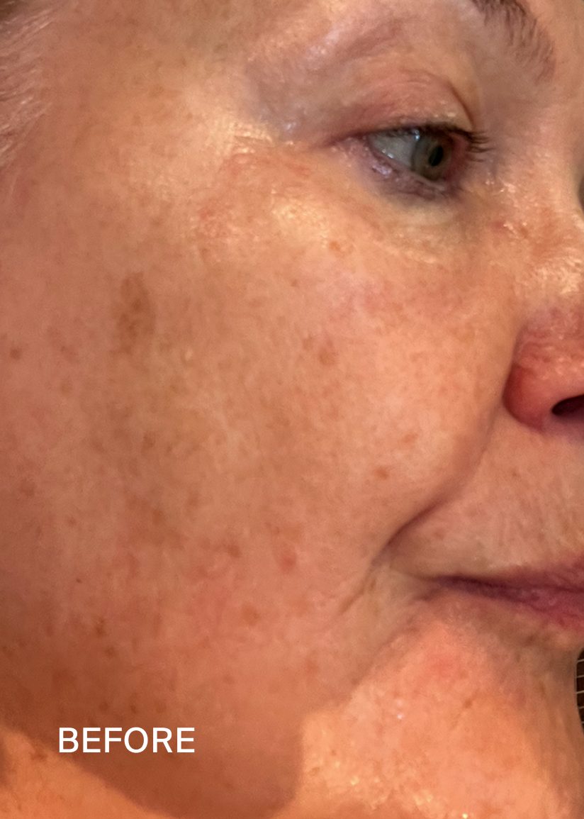 Before: close-up of a woman’s cheek in profile