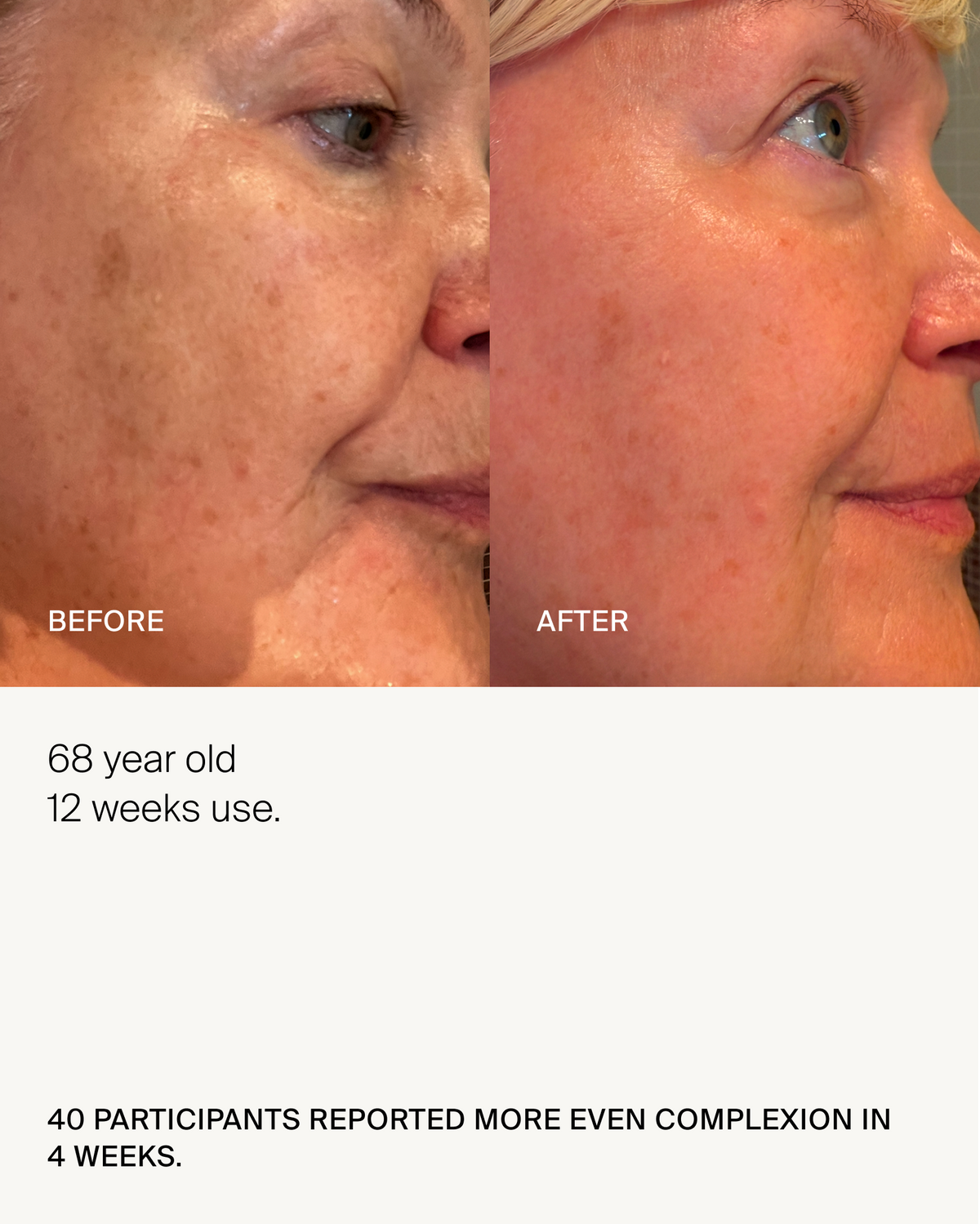 Before and after photos of a 68-year-old woman's cheek after 12 weeks of use, with the caption: 40 participants reported more even complexion in 4 weeks
